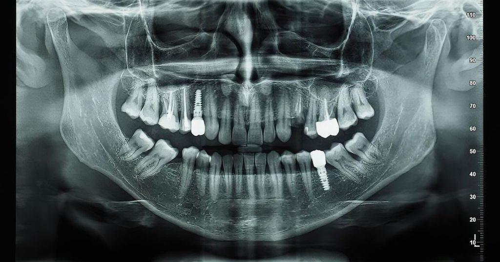Radiografía panorámica de la boca con implantes dentales