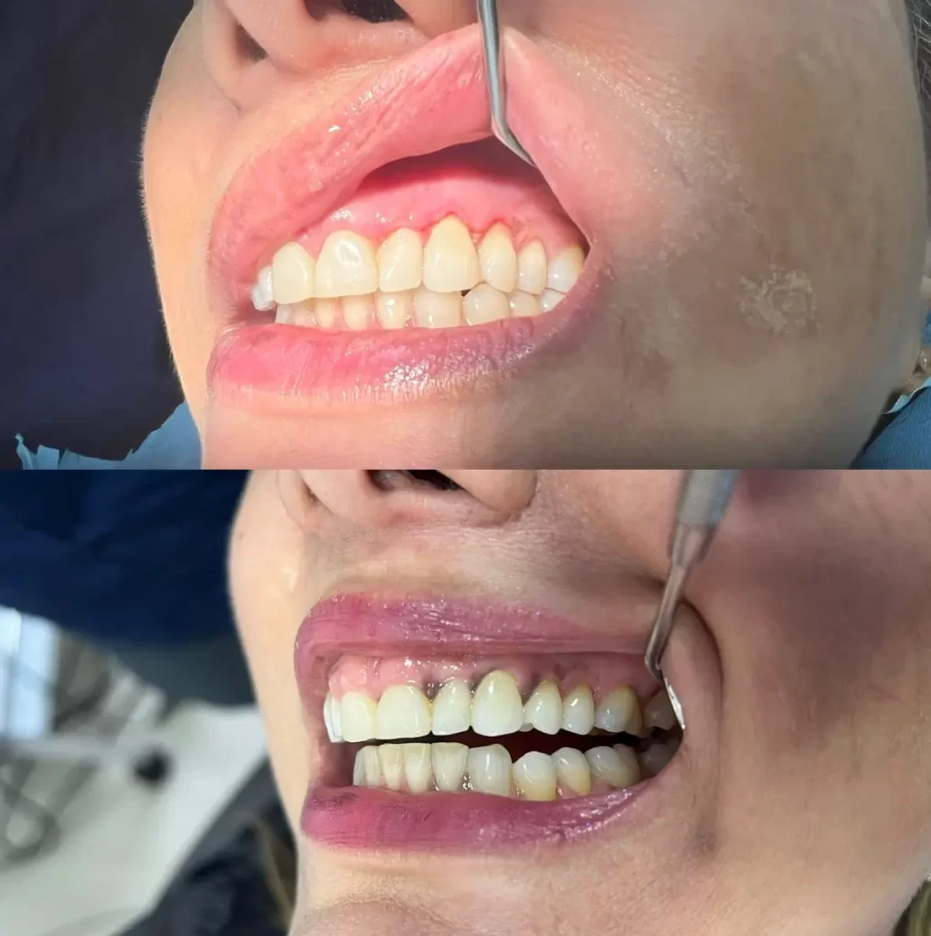 Encías antes y después de un tratamiento con láser