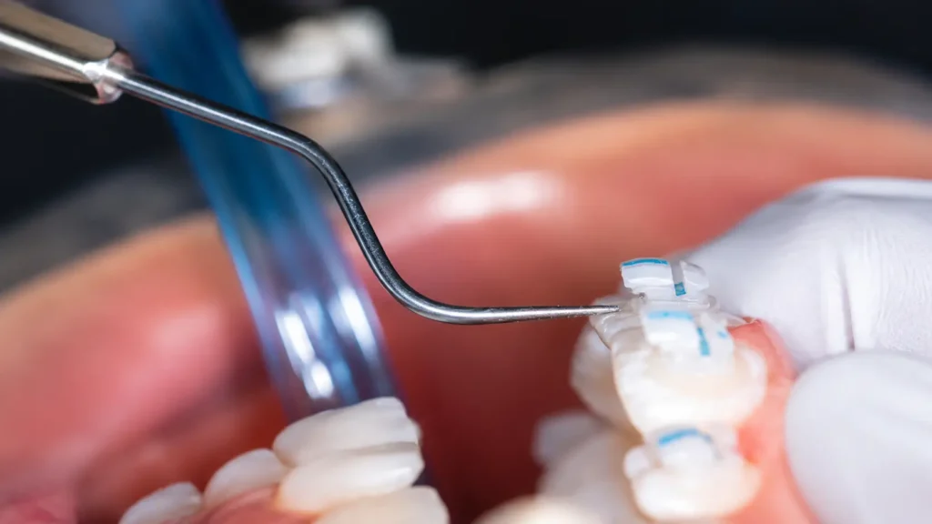 Colocación de brackets en un tratamiento de ortodoncia