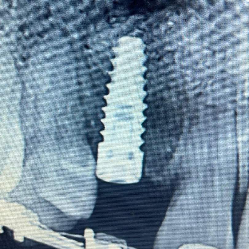 Radiografía de un implante dental colocado en el hueso del maxilar