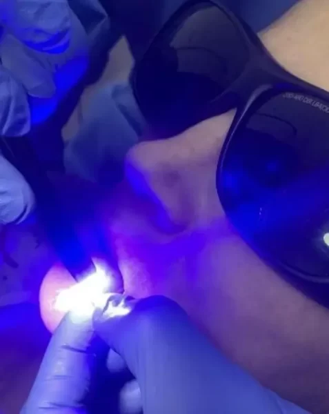 Laser_1