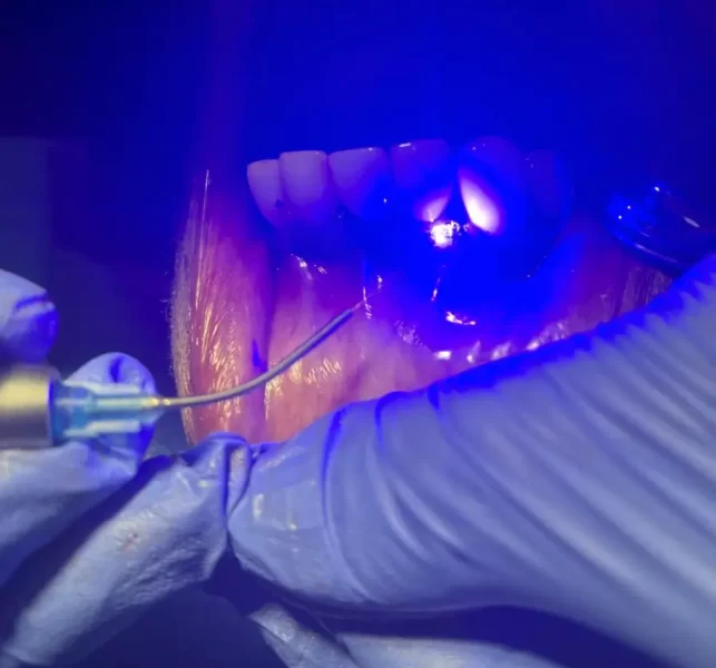 Laser_2